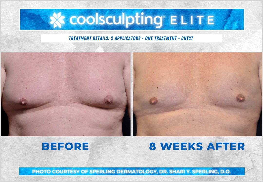 Before & After Pecs CoolSculpting in New Jersey
