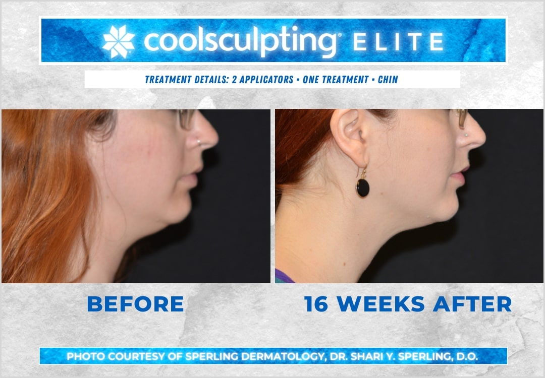 Before & After Submental Fat CoolSculpting in New Jersey
