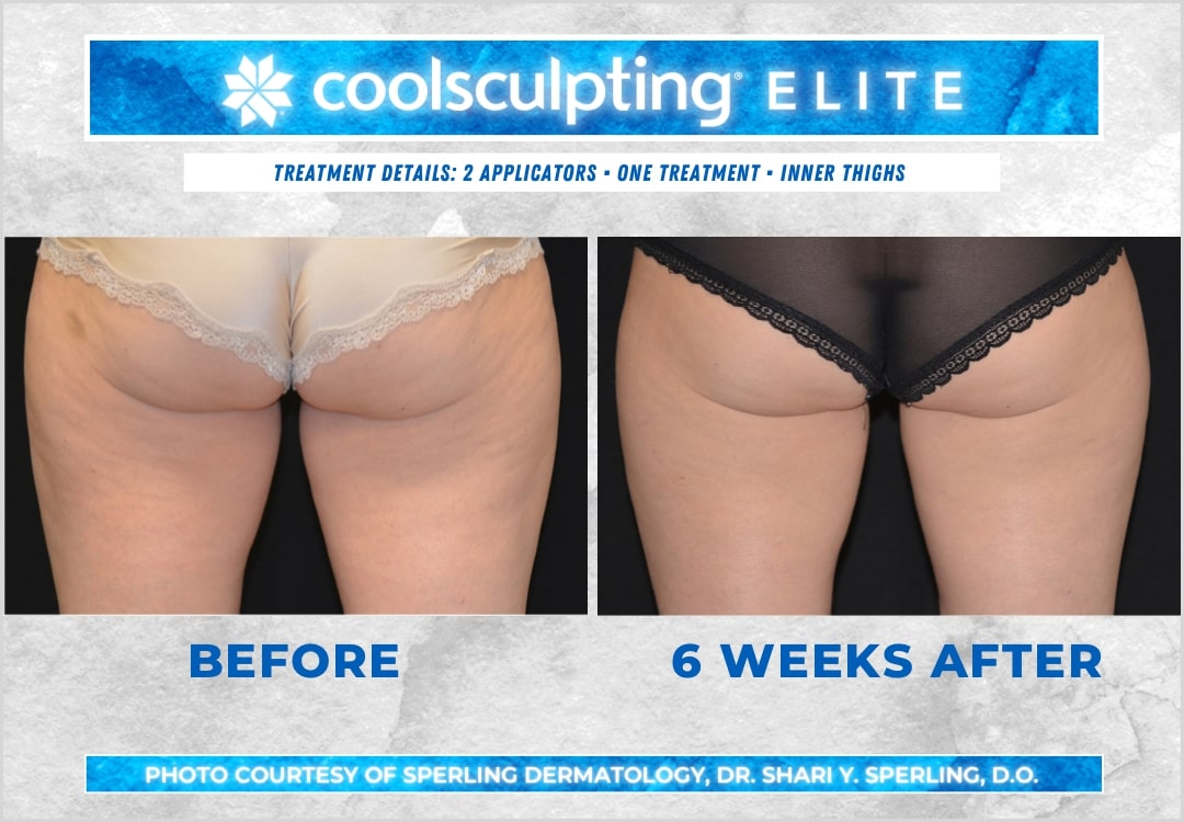 Before & After Thighs CoolSculpting in New Jersey